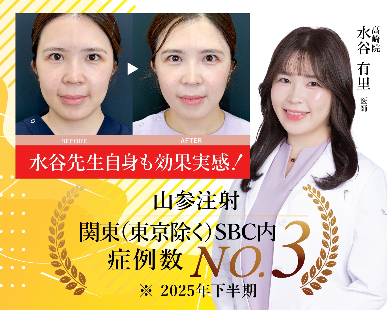 【脂肪溶解注射】山参（サンサム）注射