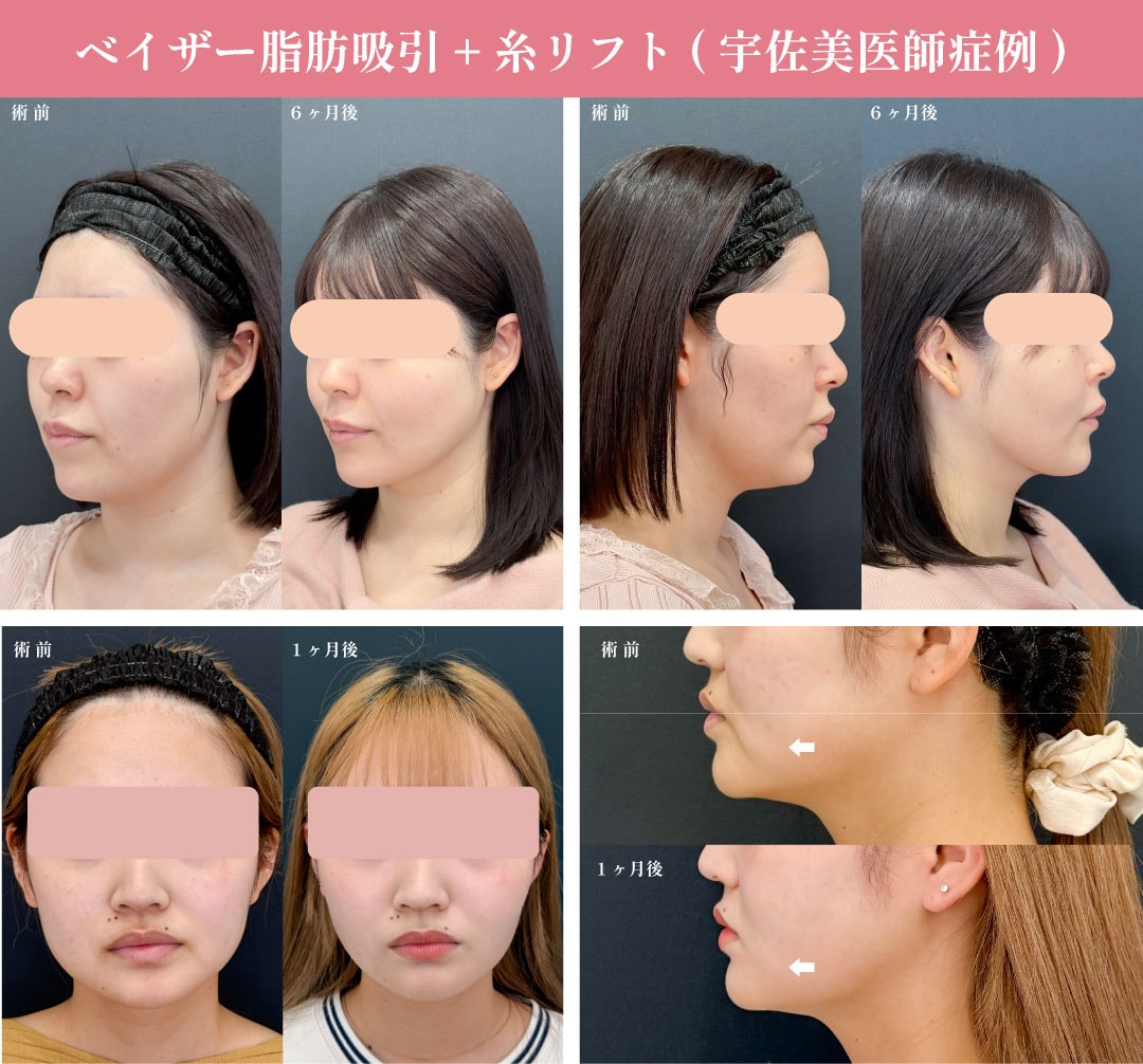 【小顔】頬・あご下の脂肪吸引＋糸リフト