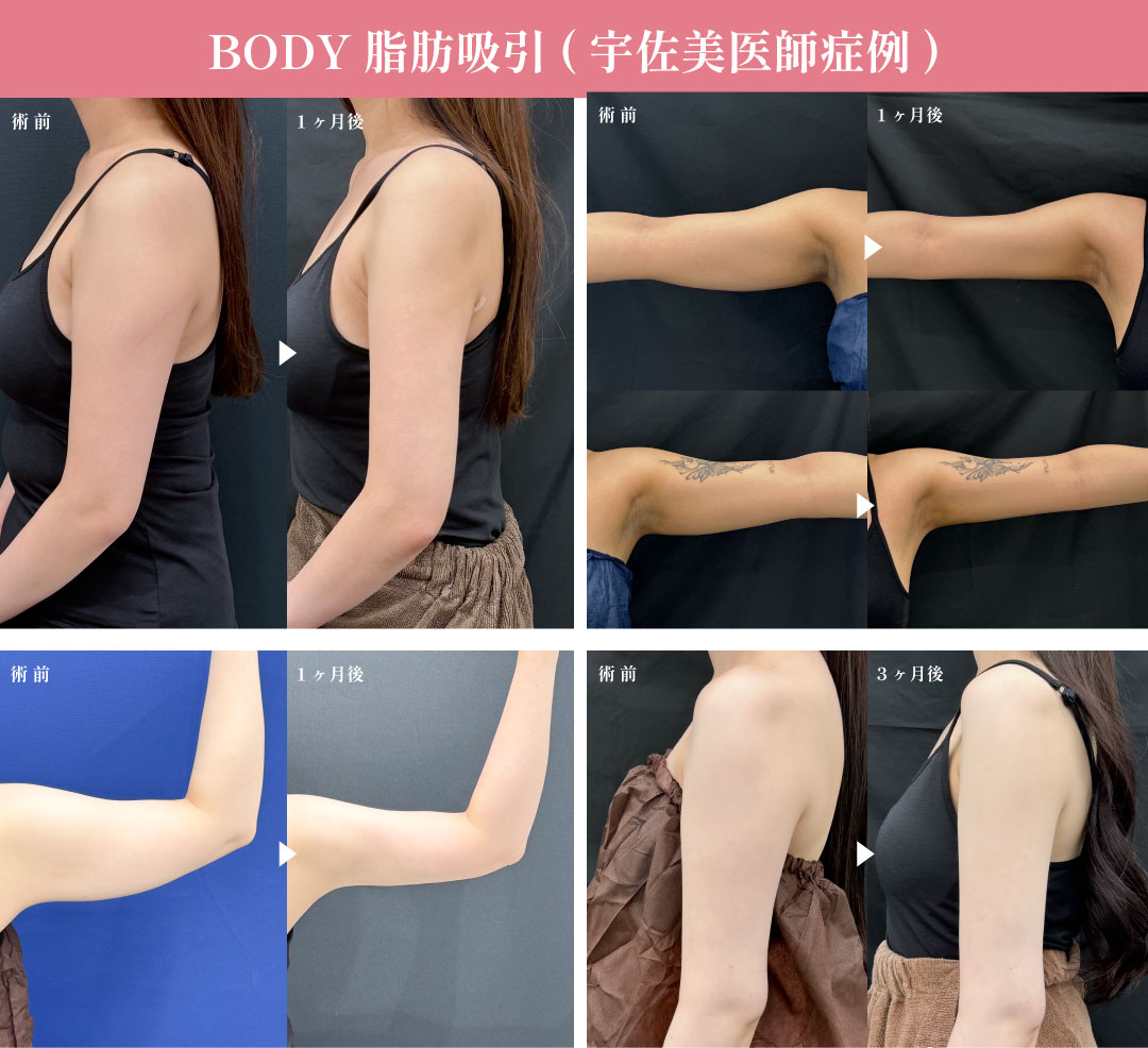 【二の腕】横・後ろ姿に自信！脂肪吸引で“振袖”解消