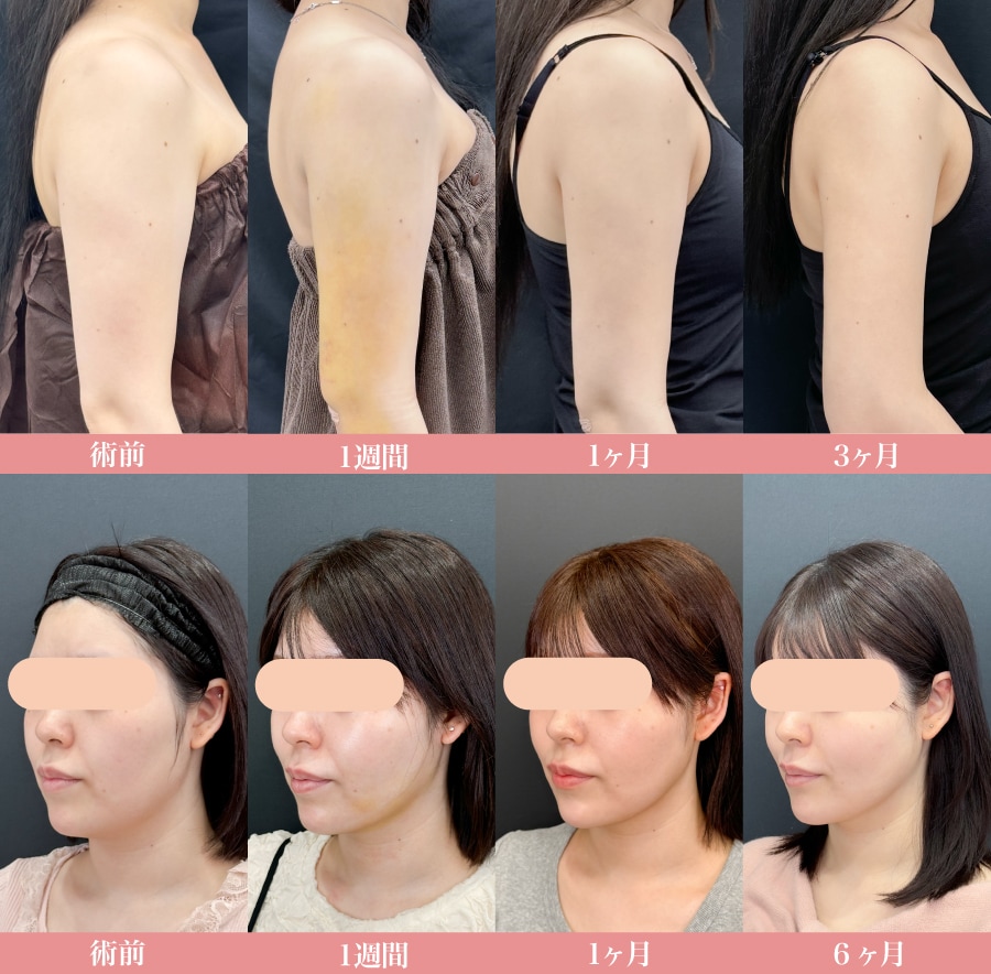 腫れ・内出血はどれくらい？