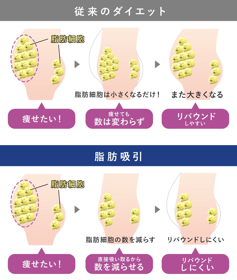 脂肪吸引の仕組み