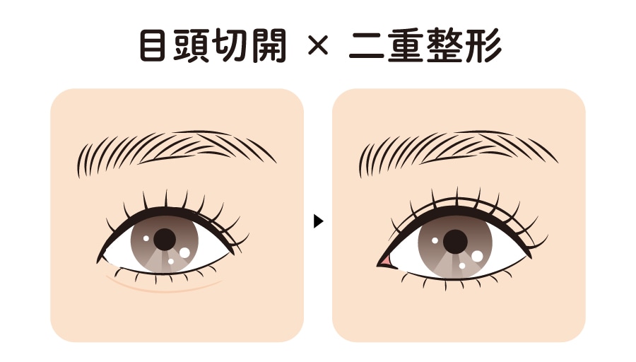 目頭切開 × 埋没法二重術(全切開二重術)