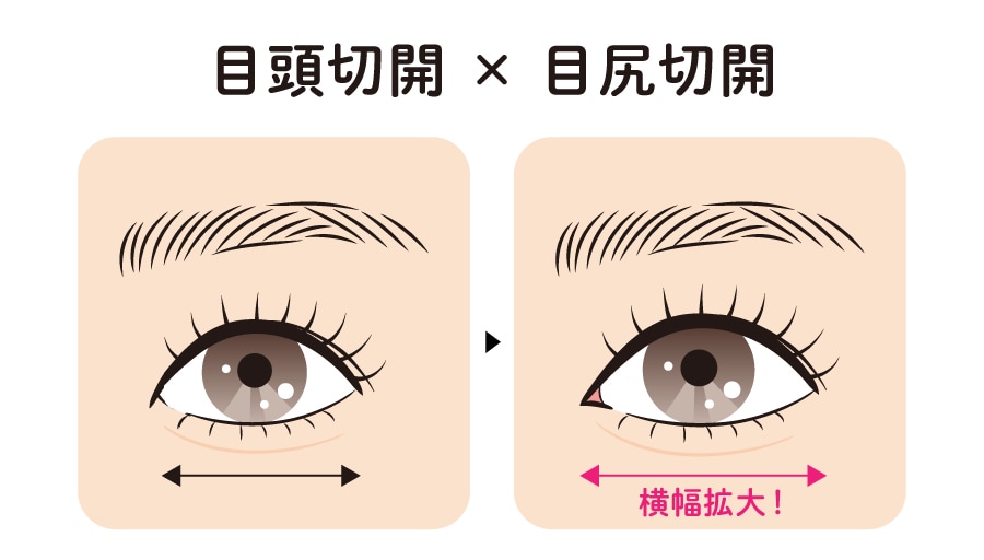 目頭切開 × 目尻切開（目元の横幅最大化）