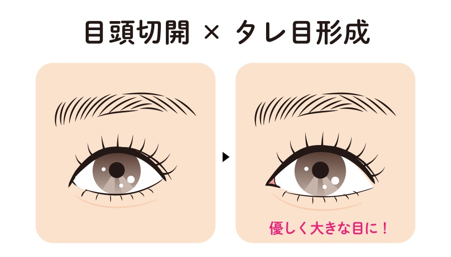 目頭切開 × タレ目形成（グラマラスライン）