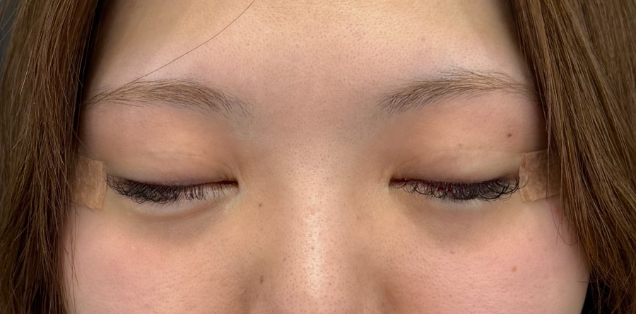 傷跡は目立ちますか？