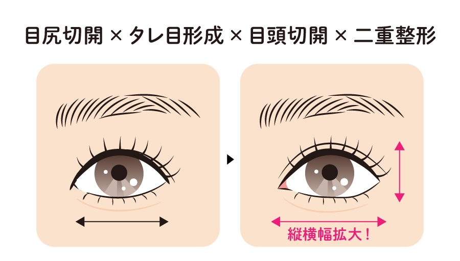 目尻切開 × タレ目 × 目頭切開 × 二重整形