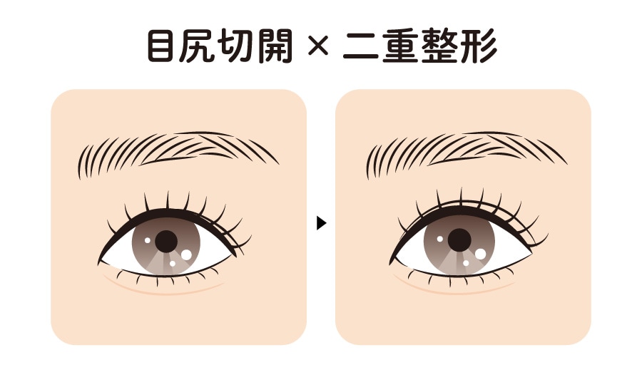目尻切開 × 二重整形(二重埋没法 / 全切開二重術)