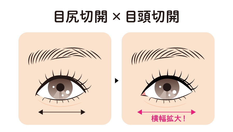 目尻切開 × 目頭切開