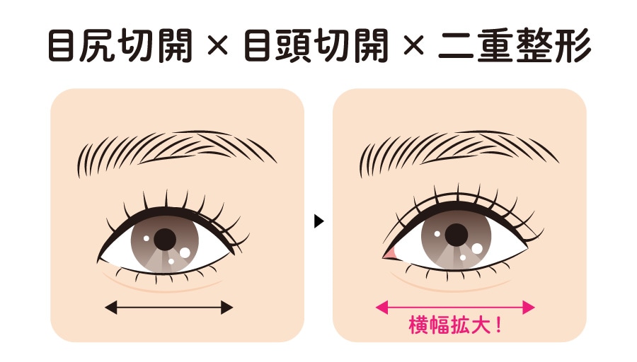 目尻切開 × 目頭切開 × 二重整形