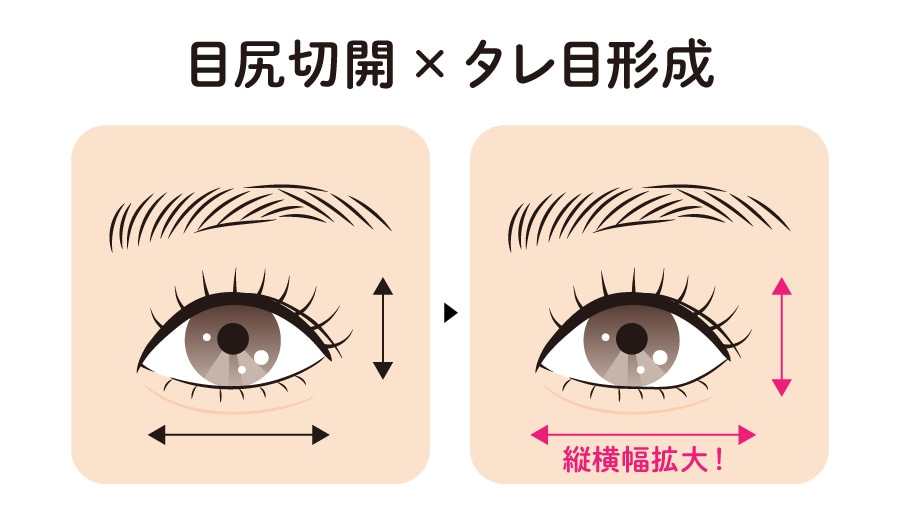 目尻切開 × タレ目形成（グラマラスライン）