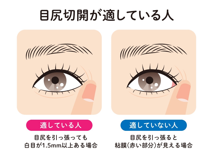目尻切開が適している目元