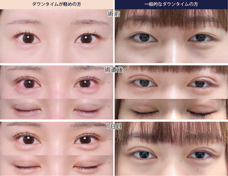 直後~1日目：腫れや内出血の出はじめ