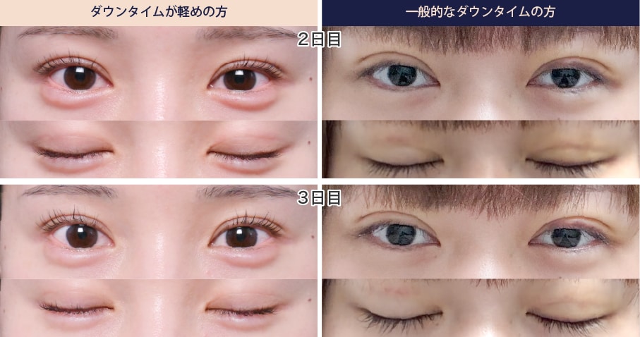 2日目~3日目：ピーク時期