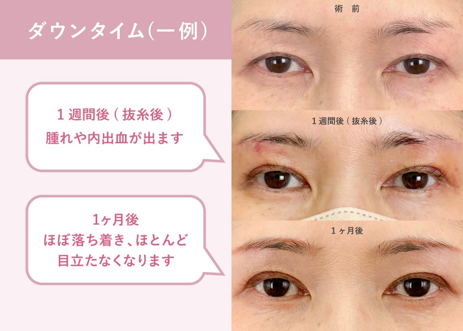 腫れ・内出血の目安