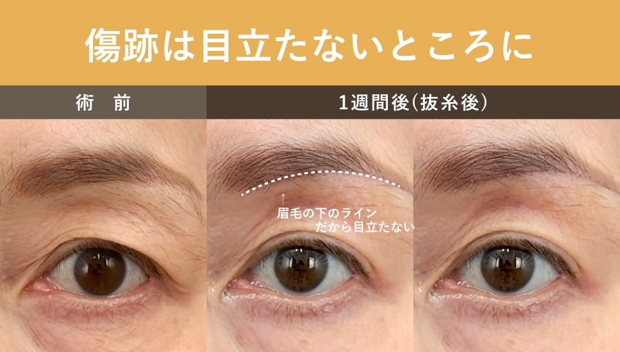 なぜ「眉下」から切開するのか