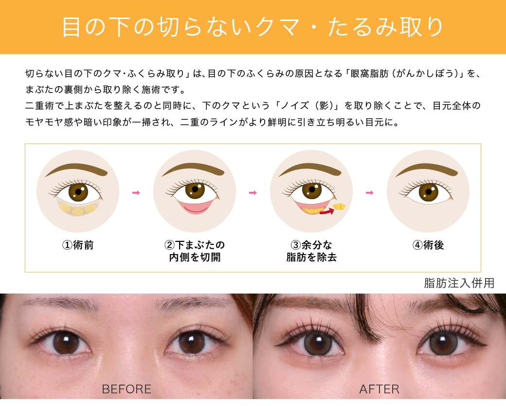 目の下の切らないクマ・たるみ取り