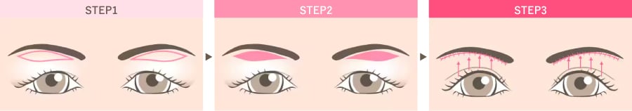 眉下切開の基本