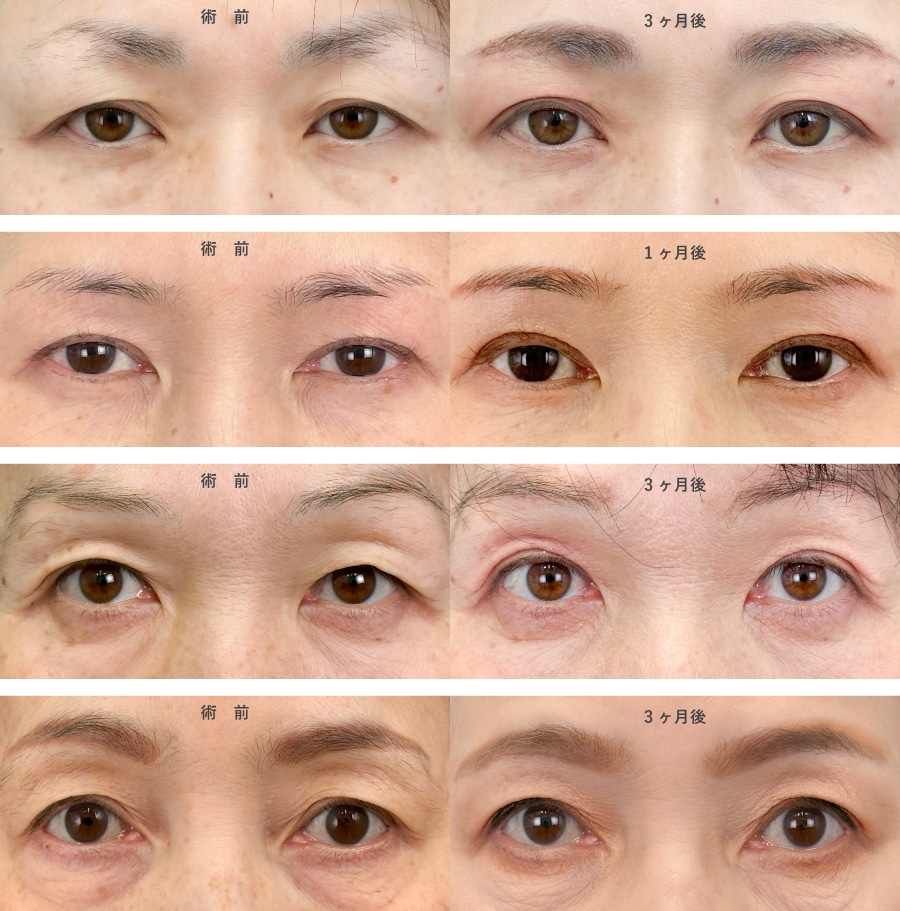 まぶたのたるみ改善症例