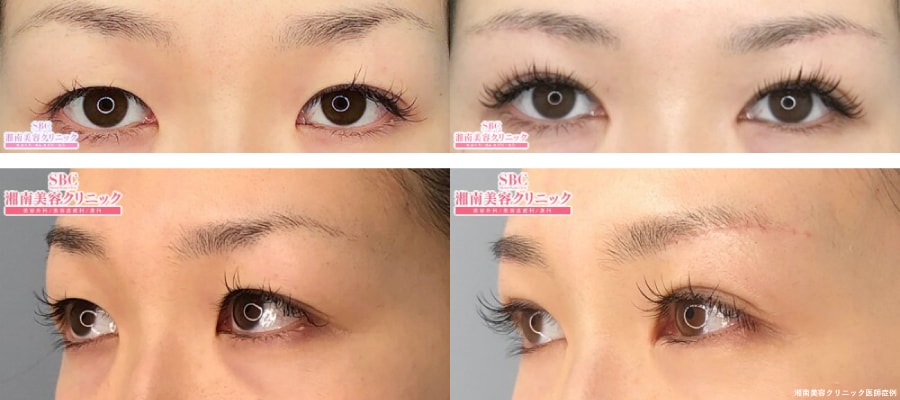 20代・30代の厚み改善症例