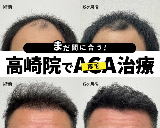 男性の薄毛のお悩みは、湘南美容クリニック高崎院で!