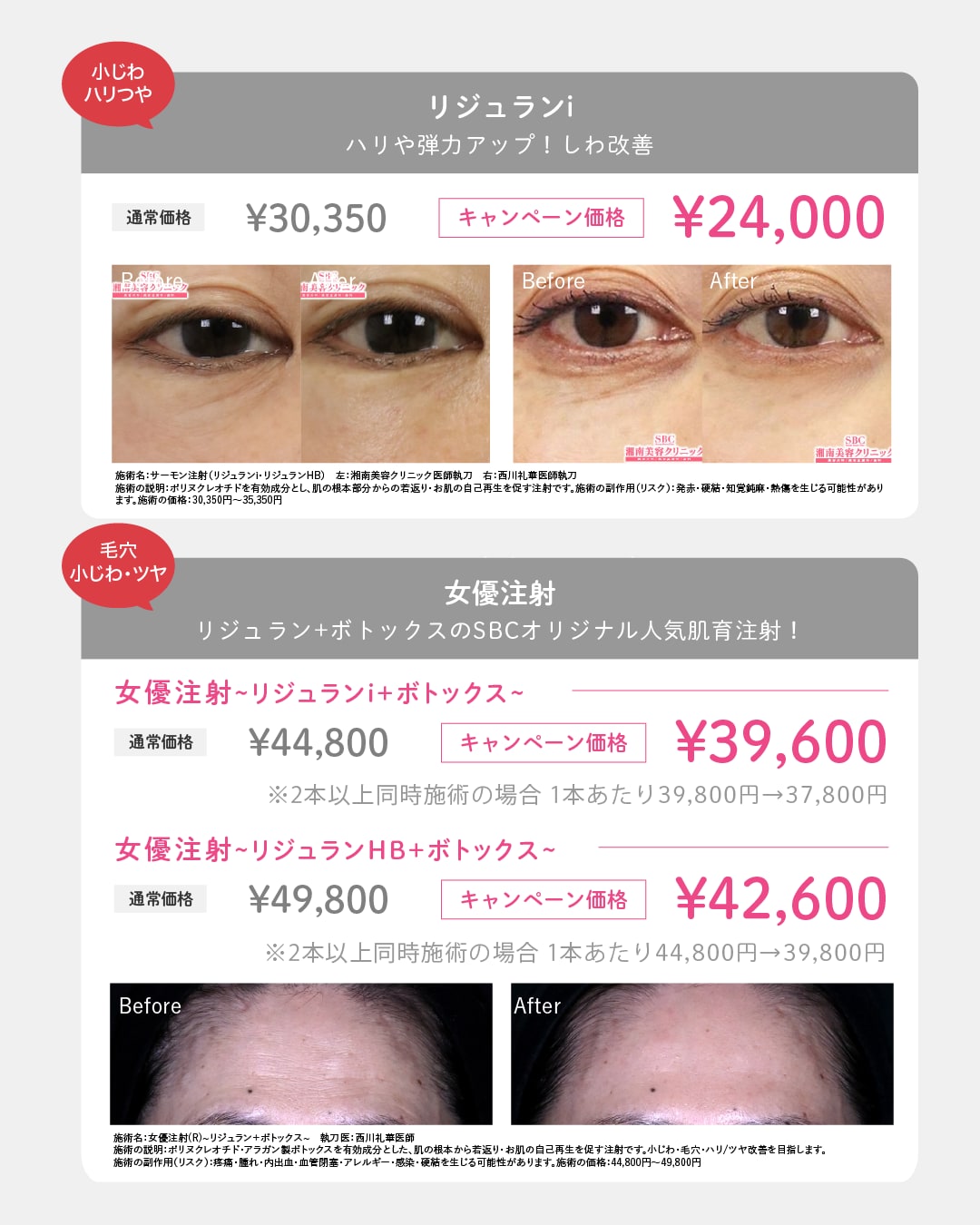 リジュラン注射