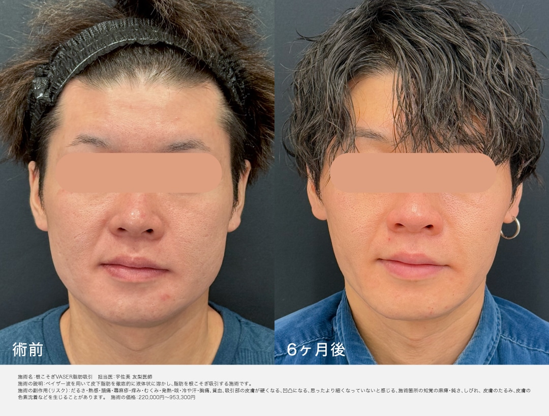 脂肪吸引