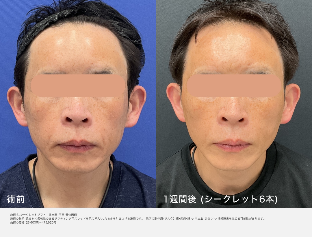 糸リフト