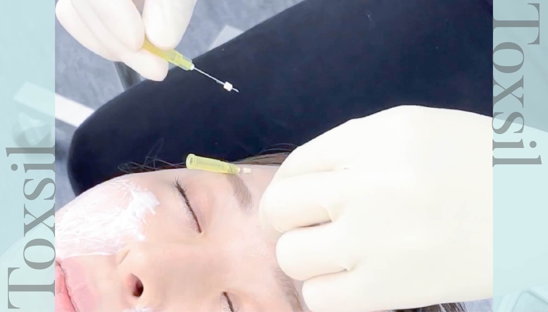 「ボツリヌス由来成分」と「リジュラン様成分」配合の特殊な糸を挿入。小顔と肌質改善を同時に。