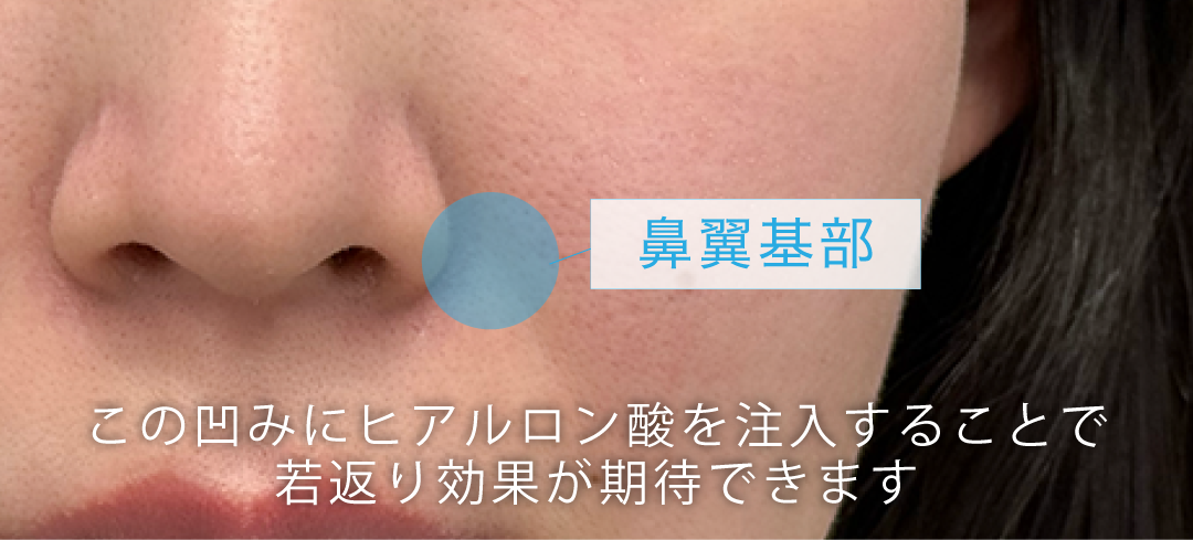 貴族フィラー(貴族ヒアル)とは