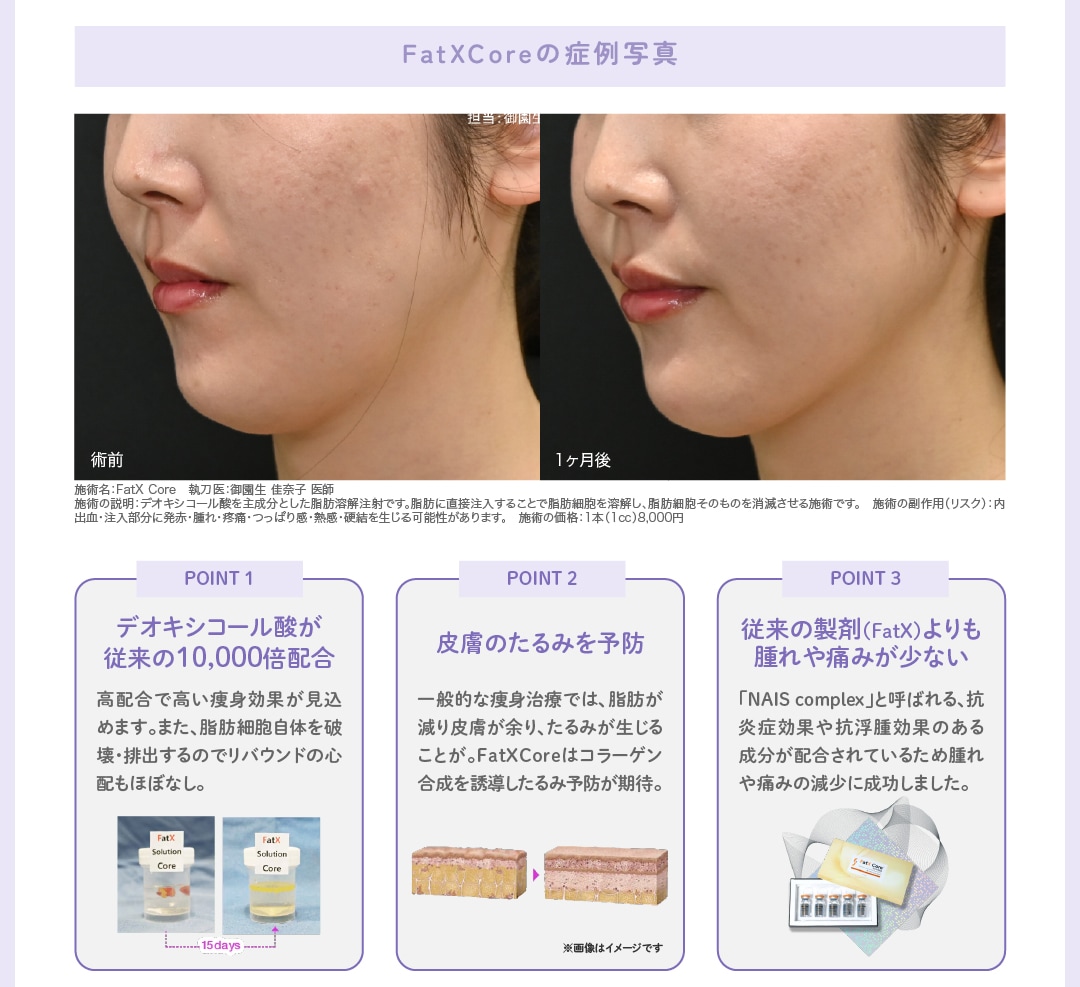 【脂肪溶解注射】FatX Core