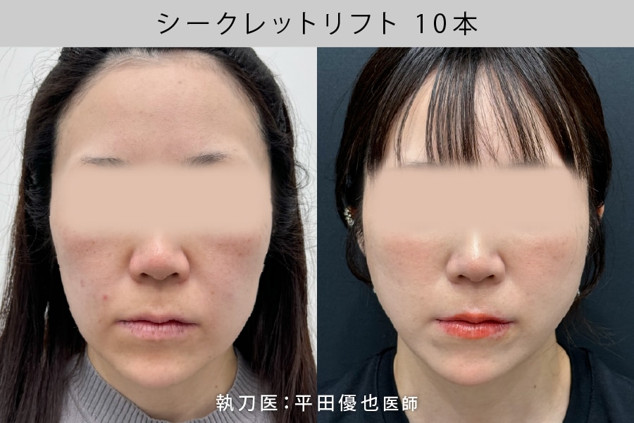 糸リフト10本