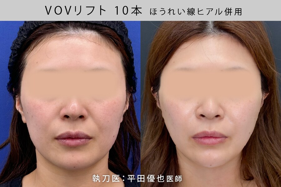 糸リフト10本×ヒアルロン酸