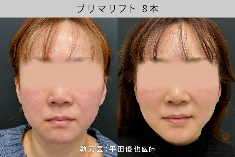 糸リフト8本