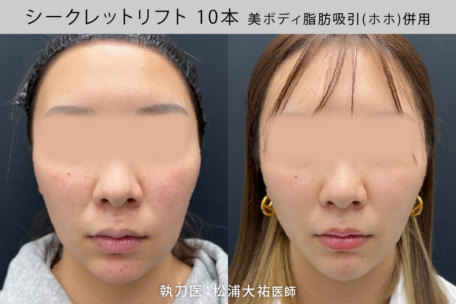 糸リフト10本×脂肪吸引(ホホ)