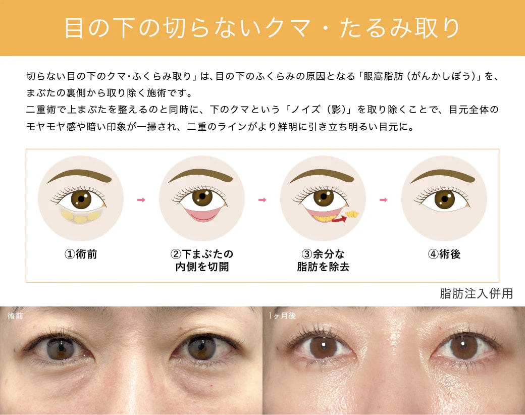 目の下の切らないクマ・たるみ取り