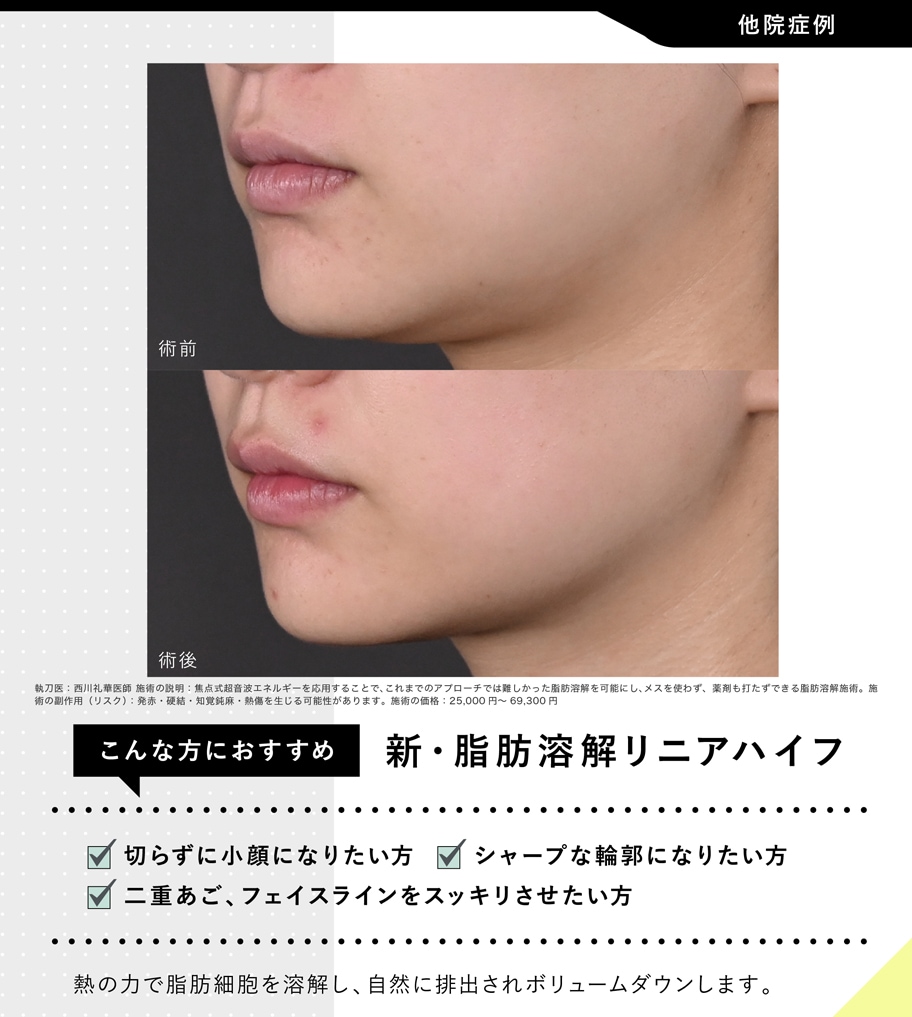 新・脂肪溶解リニアHIFU