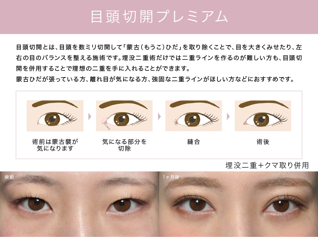 目頭切開プレミアム