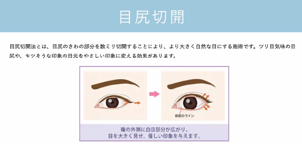 目尻切開法