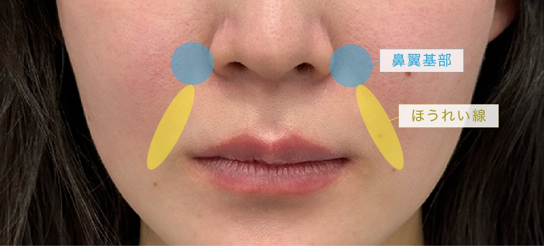 ほうれい線ヒアルじゃダメなの？