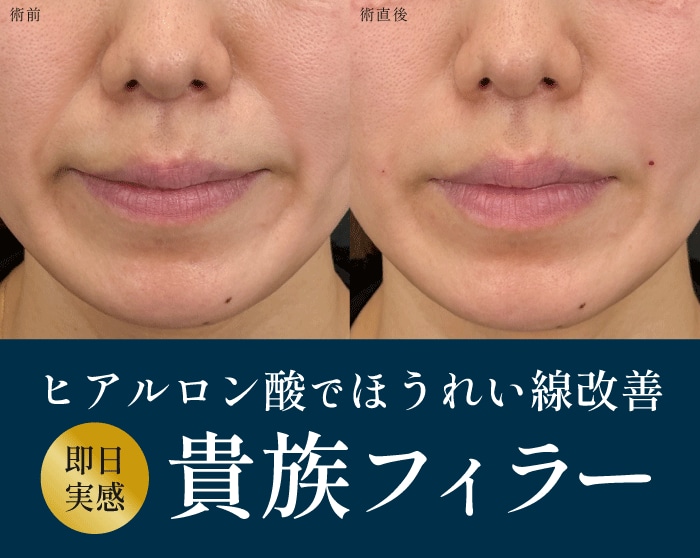 【ほうれい線改善】貴族フィラー・貴族ヒアルで即日若返り！湘南美容クリニック高崎院へ｜群馬県高崎市