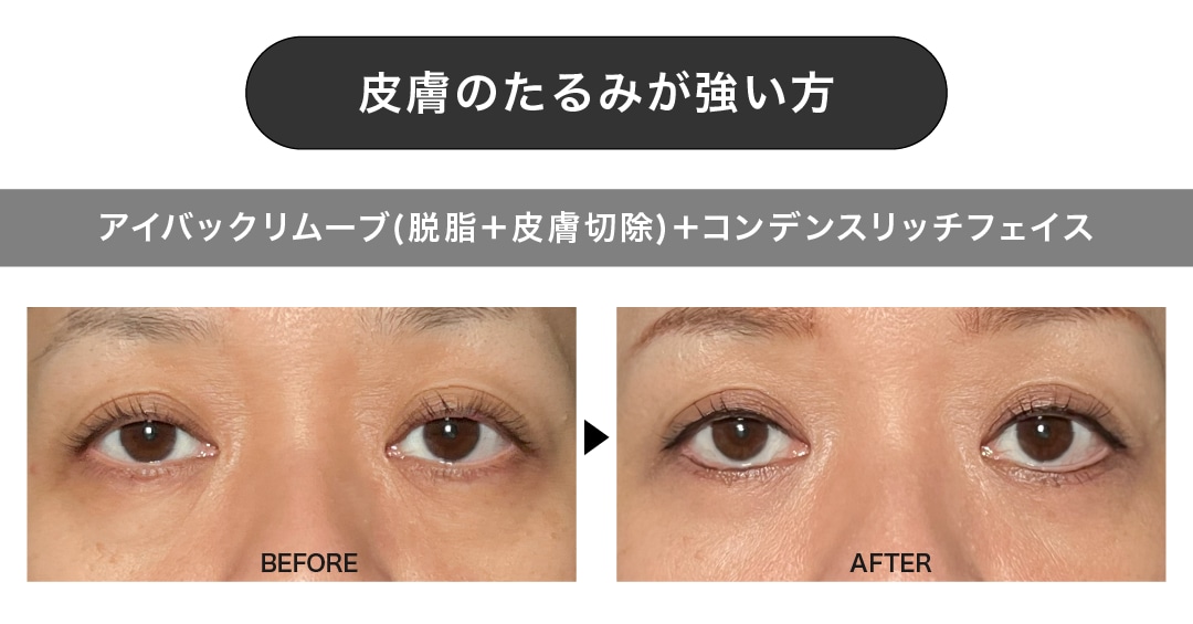 皮膚のたるみが強い目元に【アイバックリムーブ(脱脂＋余剰皮膚切除)＋コンデンスリッチフェイス】