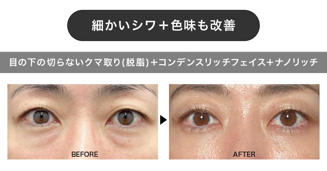 細かいシワ＋色味改善も叶うメニュー【目の下の切らないクマ取り(脱脂)+コンデンスリッチフェイス+ナノリッチ】