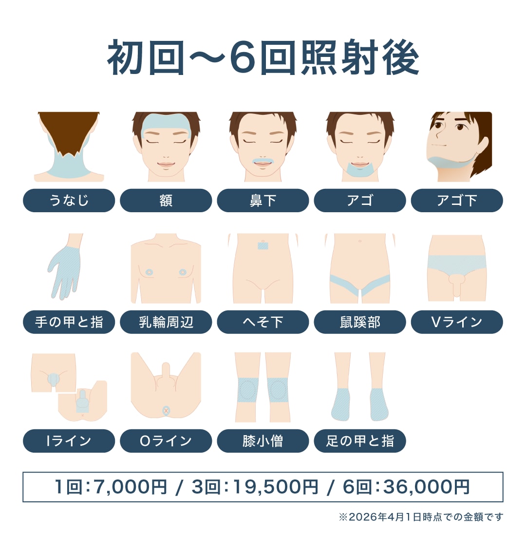 Sパーツ脱毛