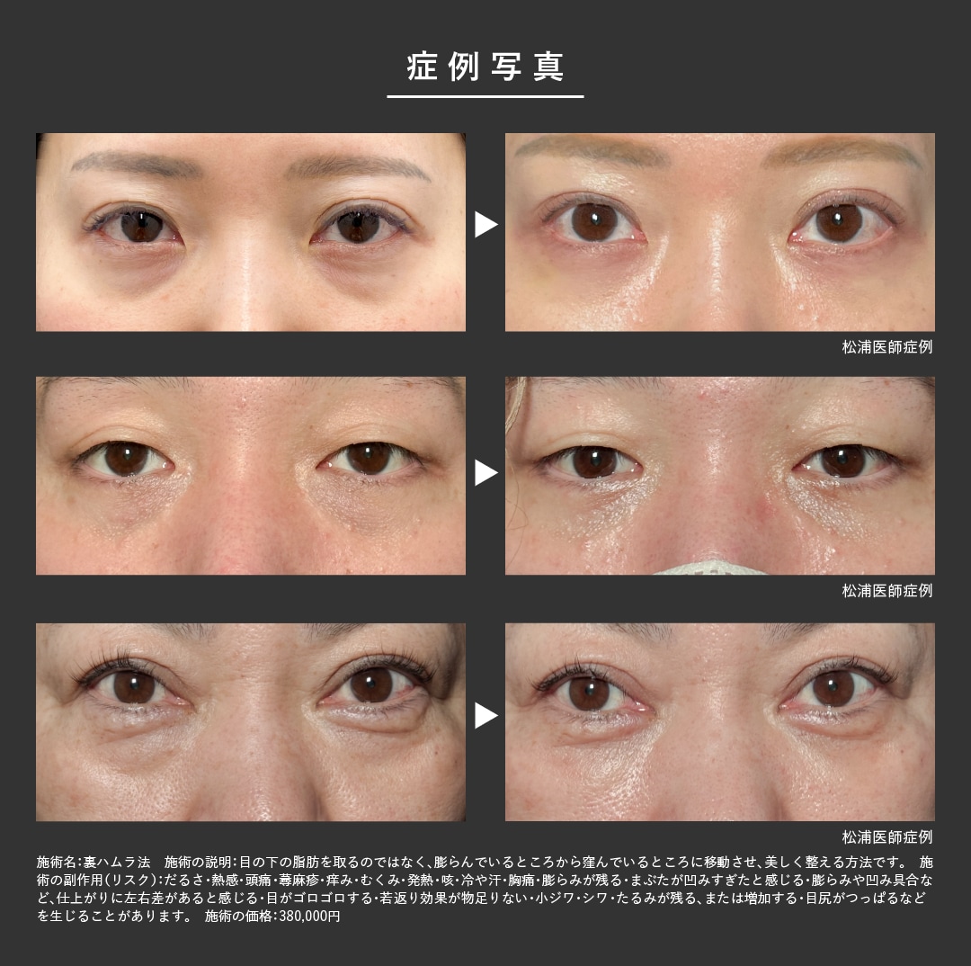 裏ハムラ法の症例写真をご覧ください