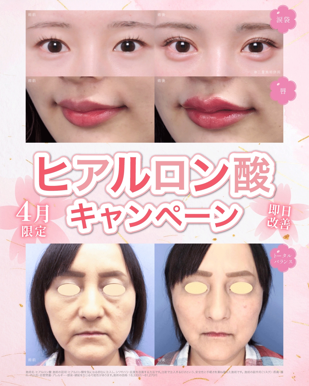 ヒアルロン酸キャンペーン