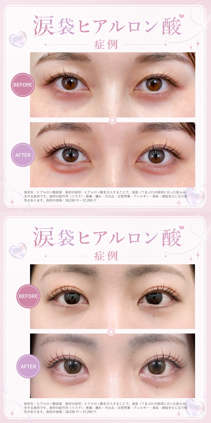 涙袋の症例