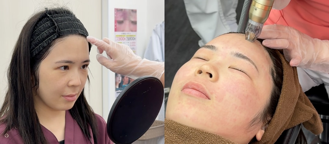 都内に行かなくてもOK！肌状態に合わせた「完全カスタム照射」