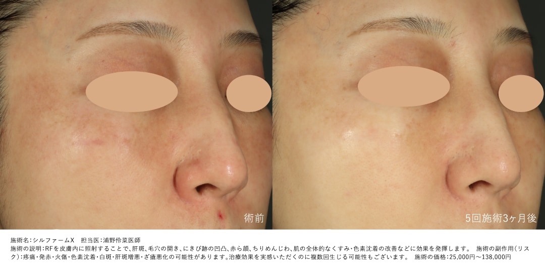 肝斑・赤みの症例