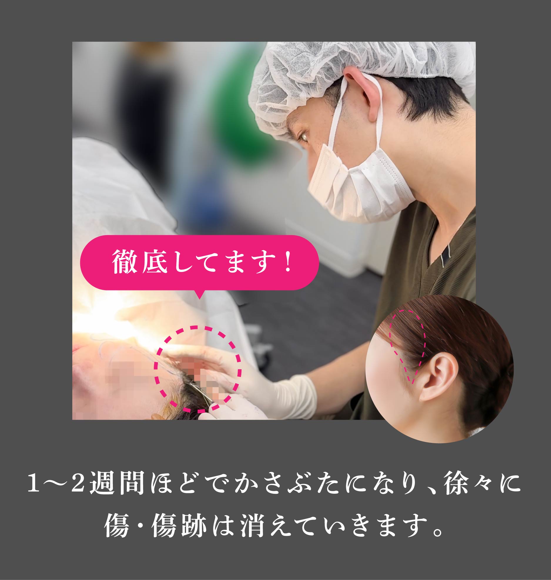 髪の毛の中に隠れるため顔表面に大きな傷は残りません