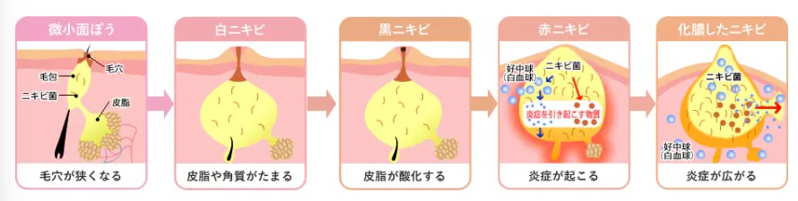 ニキビってなんでできるの?